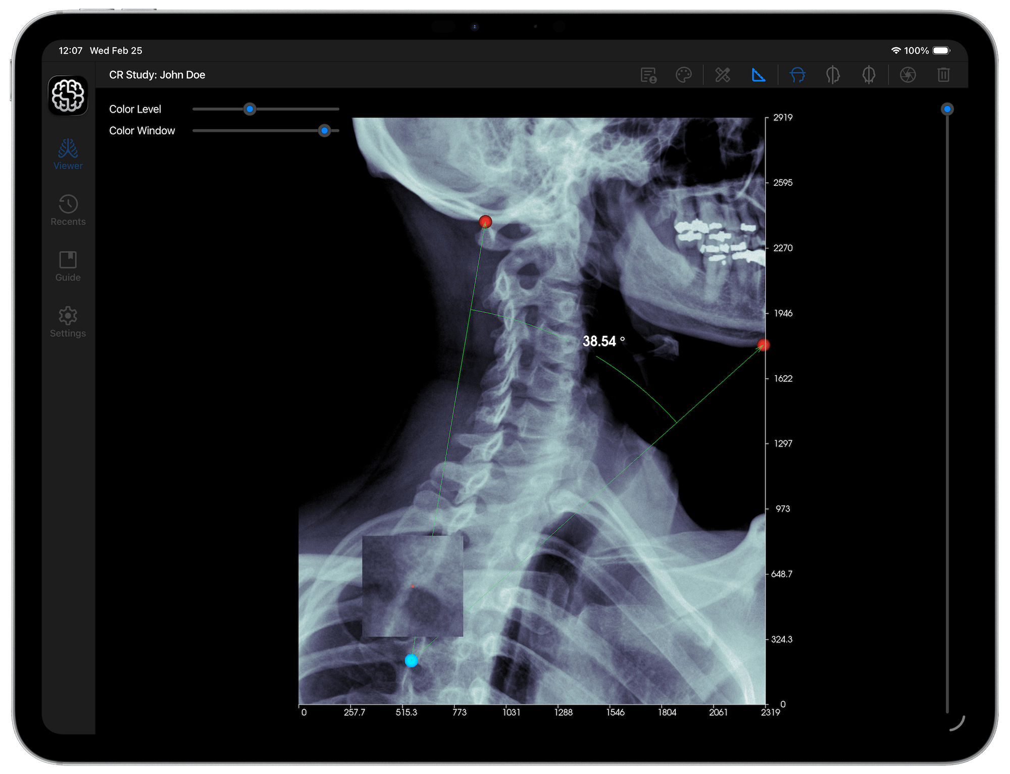 DICOM Studio Go on iPad - Angle Tool