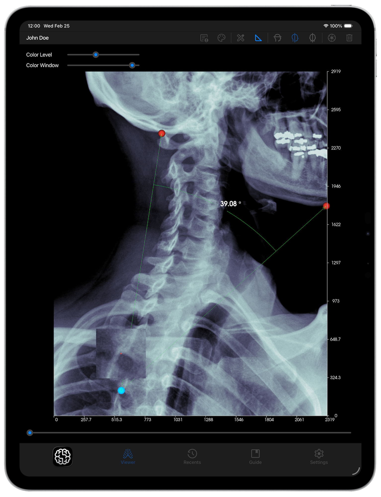 DICOM Studio Go on iPad - Angle Tool