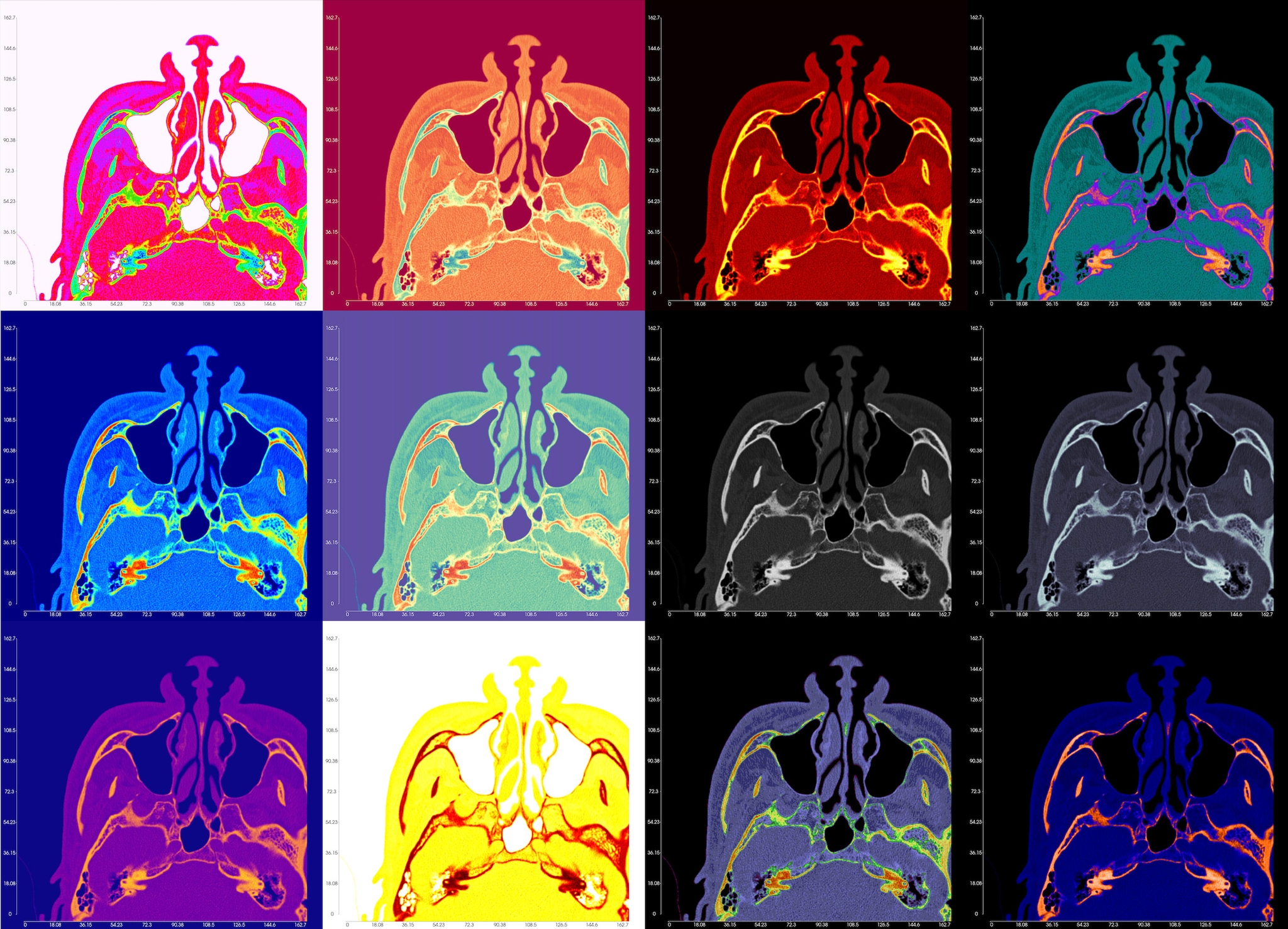 DICOM Slices with Colormap Options Applied