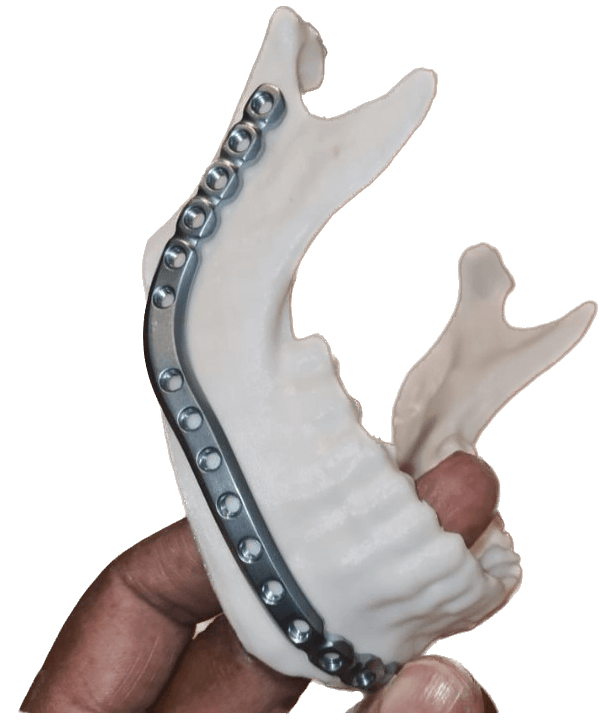 3D Printed Model Used As a Guide for a Metal Implant