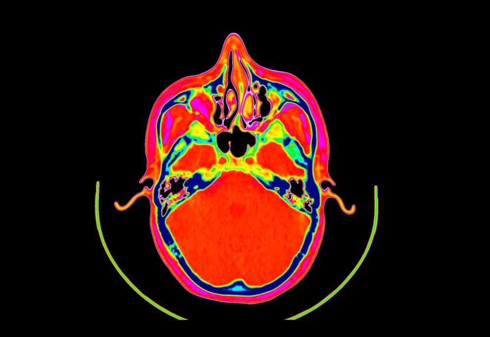 DICOM Image with 'Gist_ncar_r' colormap applied, and base color set to black