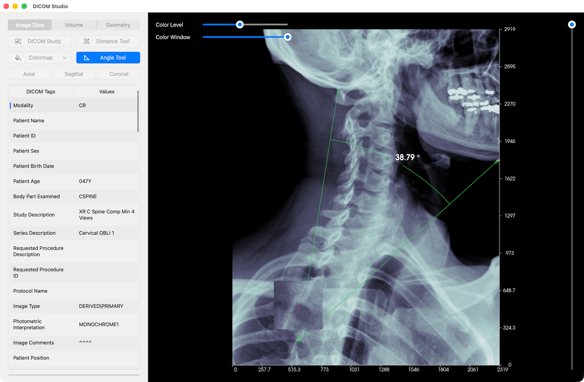 Measure Angle Tool - DICOM Studio