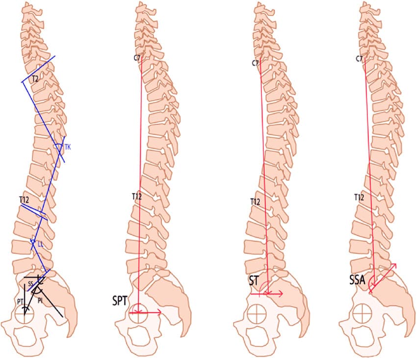Angle measurements in full length spine radiographs