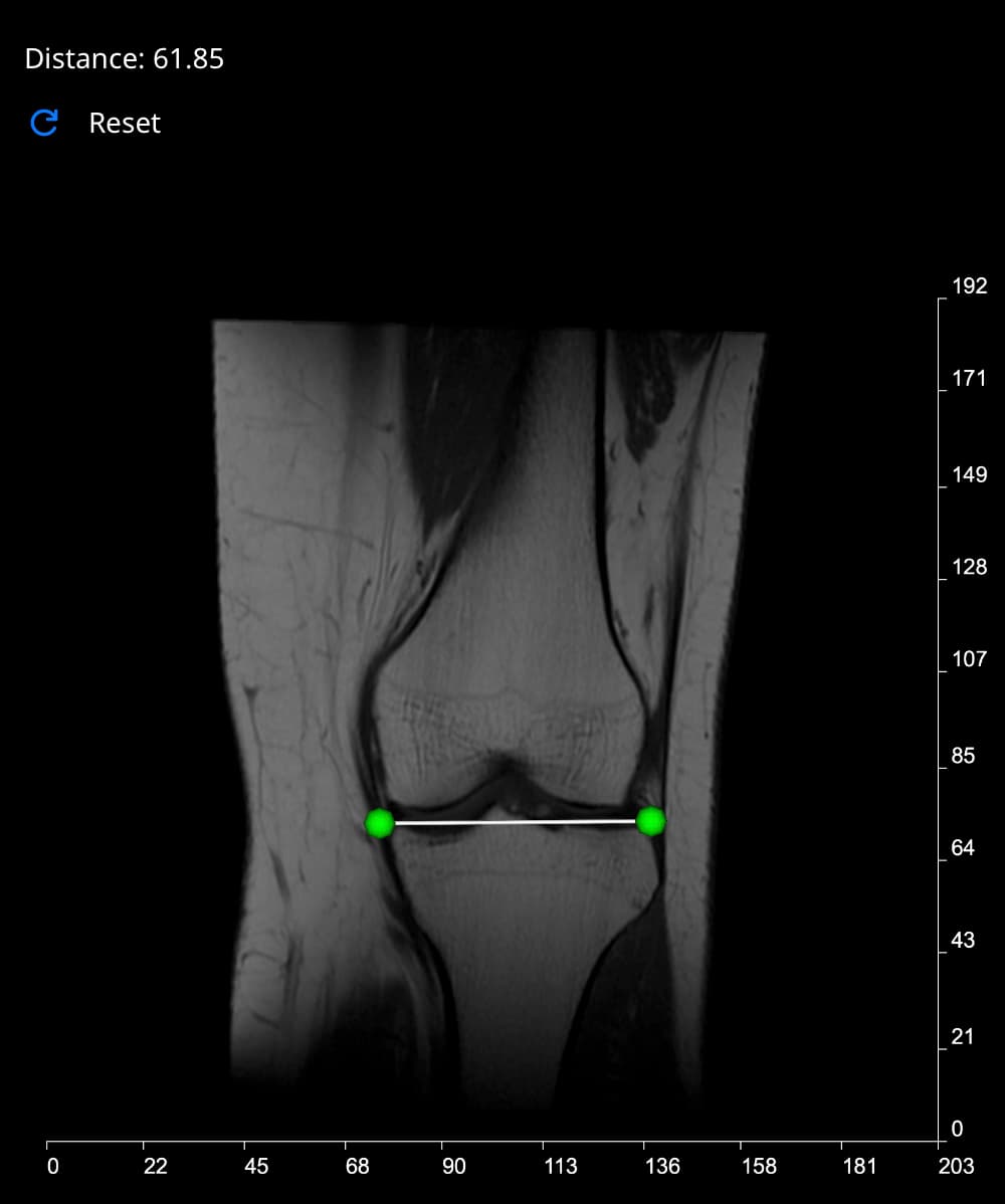 Angle measurements in full length spine radiographs