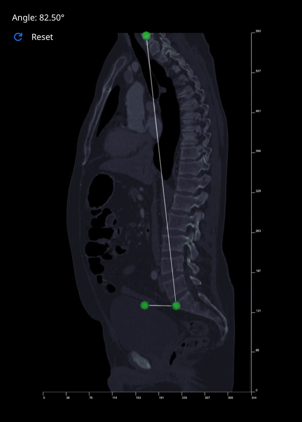 Spinal Tilt angle measurement in Vista